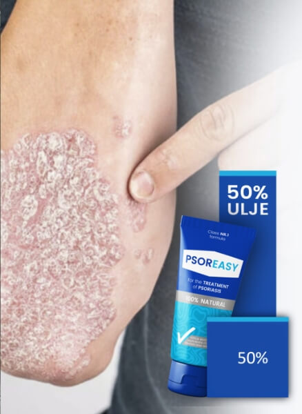 Si të përdorni Psoreasy Udhëzime